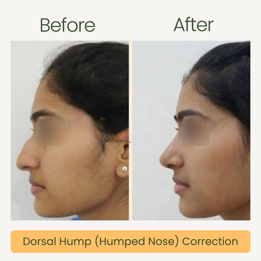 Dorsal Hump Correction 2