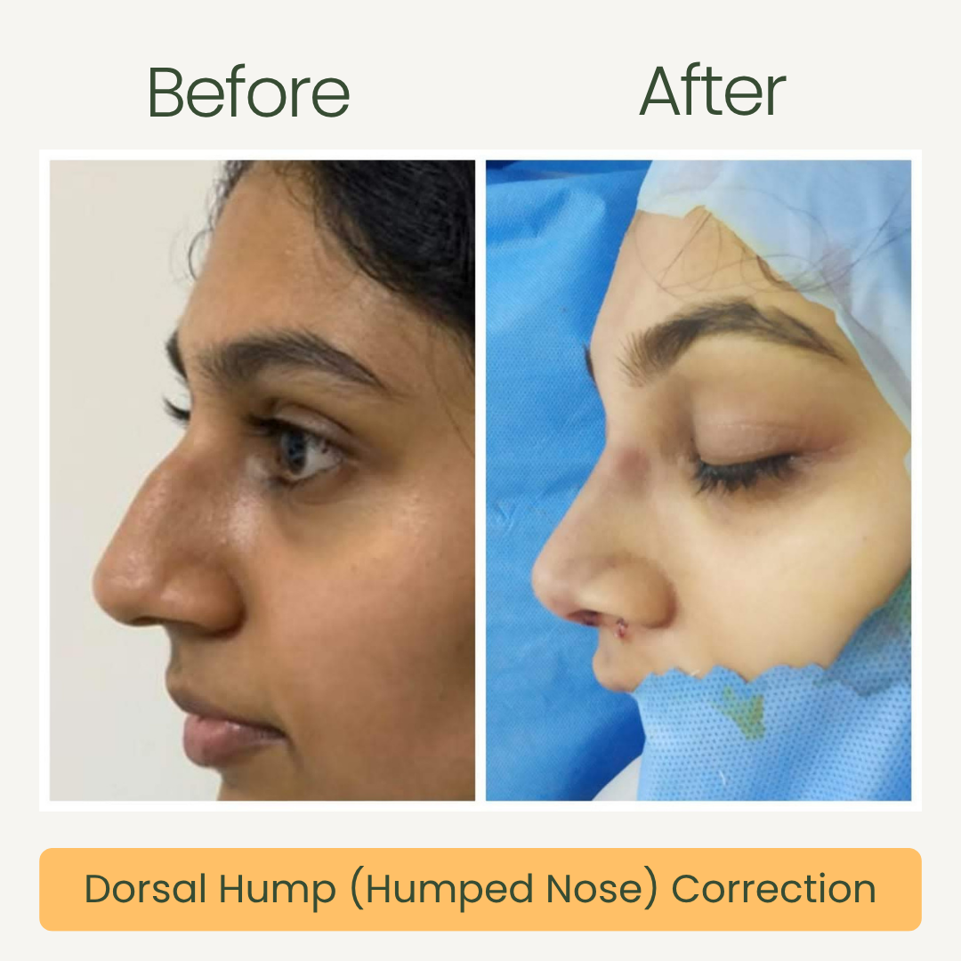 Dorsal Hump Correction
