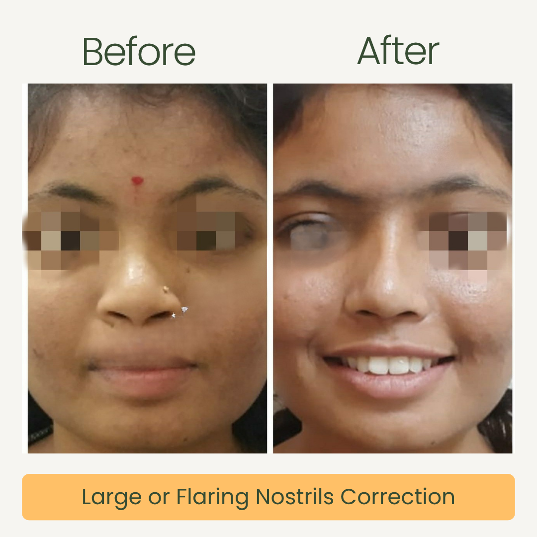 Large Nostrils Correction