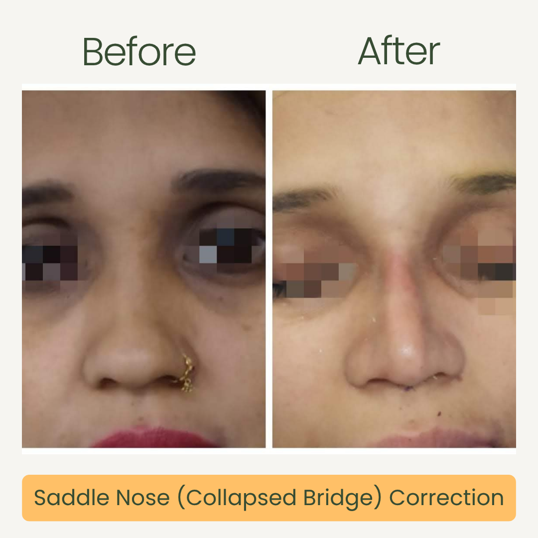 Saddle Nose Correction