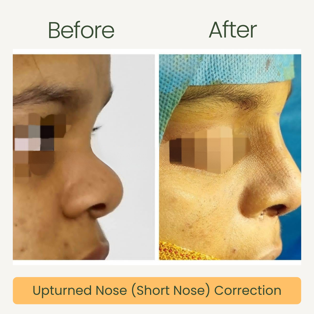 Upturned Nose Correction